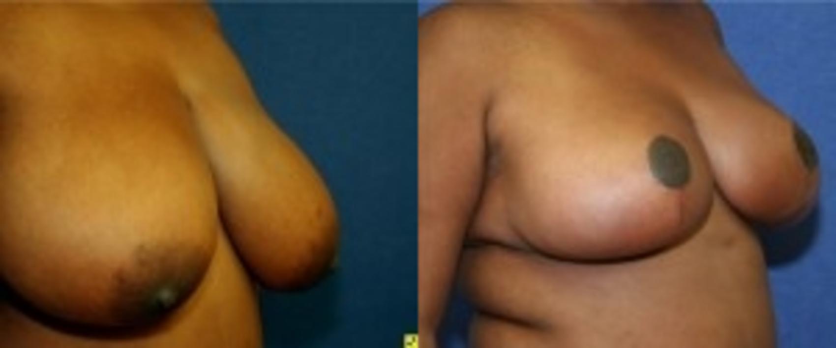 Before & After Breast Reduction Case 50 Right Oblique View in Ann Arbor, MI