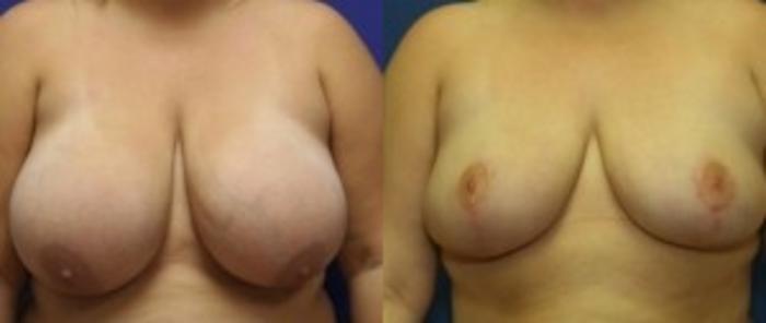 Before & After Breast Reduction Case 51 Front View in Ann Arbor, MI