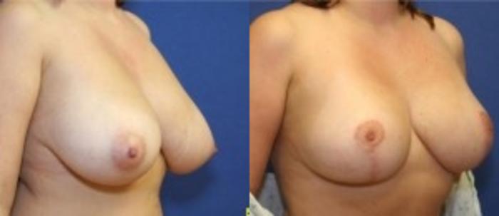 Before & After Breast Reduction Case 52 Right Oblique View in Ypsilanti, MI