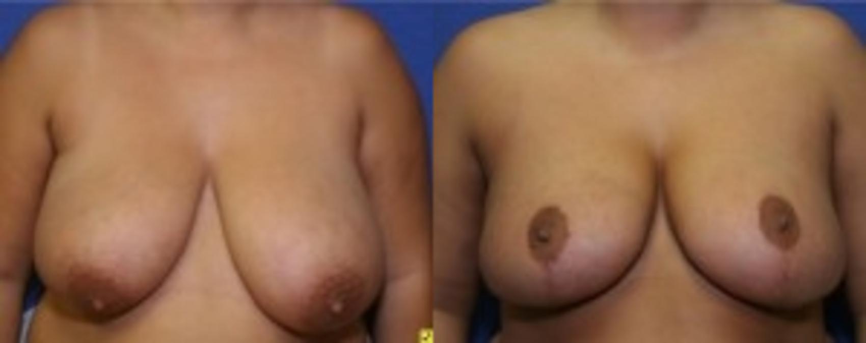 Before & After Breast Reduction Case 53 Front View in Ypsilanti, MI