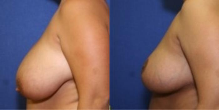 Before & After Breast Reduction Case 53 Left Side View in Ann Arbor, MI