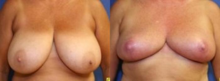Before & After Breast Reduction Case 55 Front View in Ann Arbor, MI