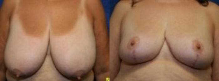 Before & After Breast Reduction Case 56 Front View in Ypsilanti, MI