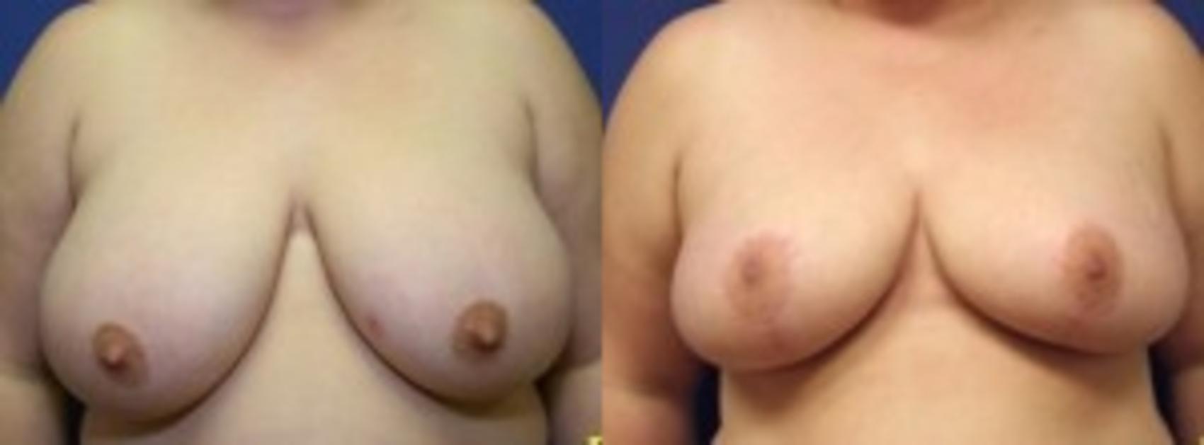 Before & After Breast Reduction Case 57 Front View in Ann Arbor, MI