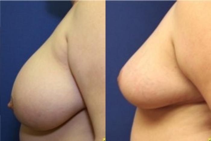Before & After Breast Reduction Case 57 Left Side View in Ann Arbor, MI