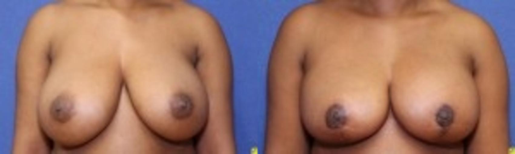 Before & After Breast Reduction Case 58 Front View in Ann Arbor, MI