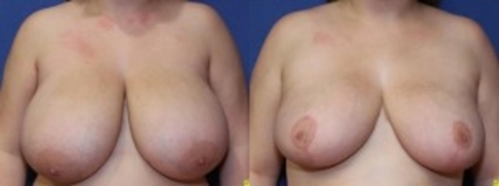 Before & After Breast Reduction Case 59 Front View in Ypsilanti, MI