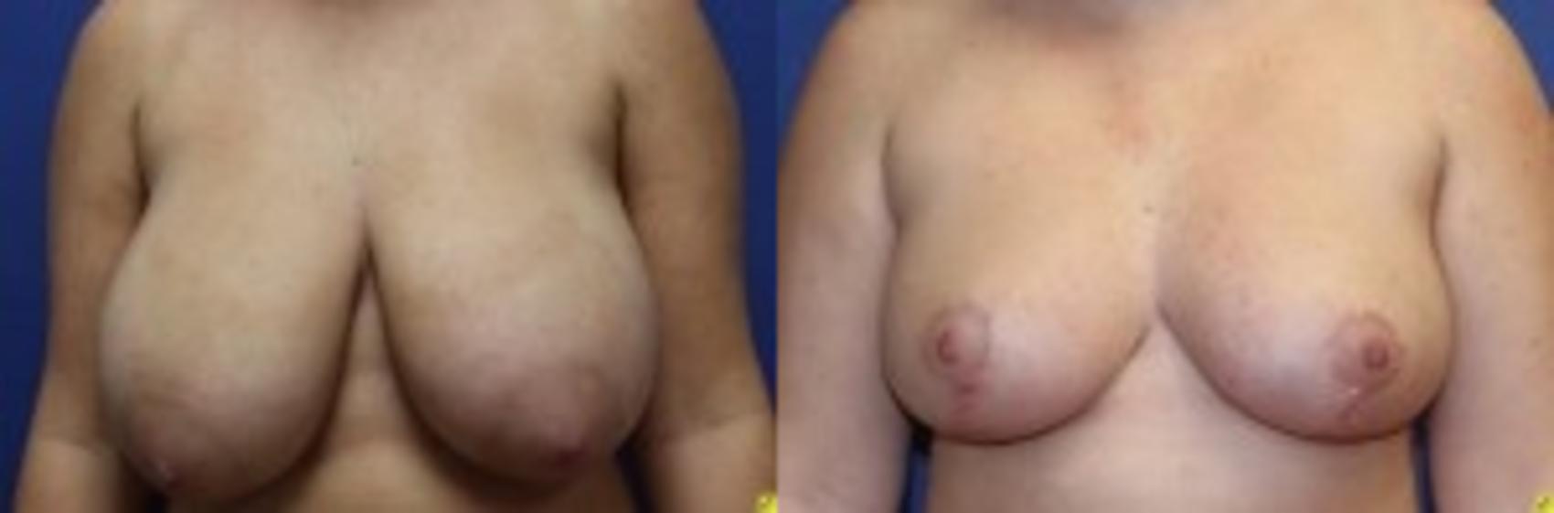Before & After Breast Reduction Case 60 Front View in Ypsilanti, MI