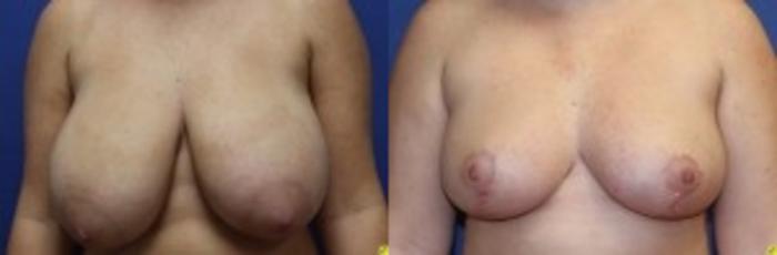 Before & After Breast Reduction Case 60 Front View in Ann Arbor, MI