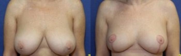 Before & After Breast Reduction Case 61 Front View in Ann Arbor, MI