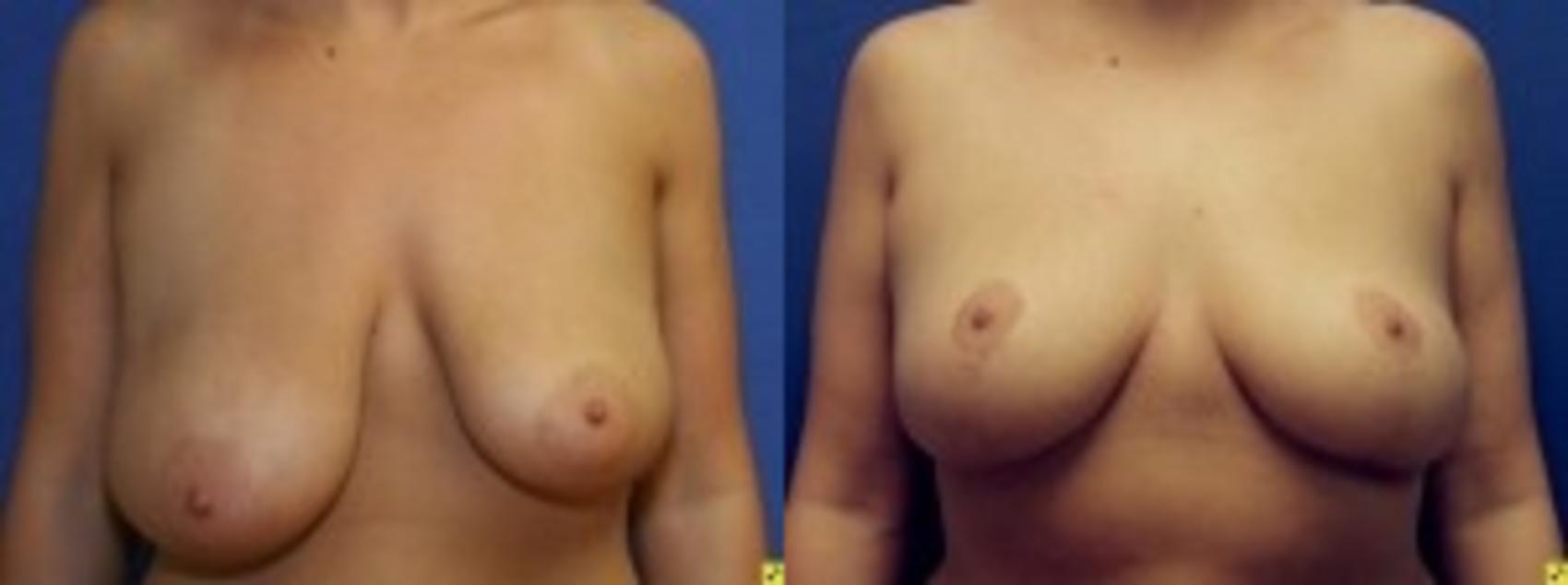 Before & After Breast Reduction Case 62 Front View in Ann Arbor, MI