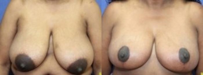Before & After Breast Reduction Case 63 Front View in Ypsilanti, MI