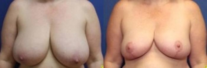 Before & After Breast Reduction Case 64 Front View in Ypsilanti, MI