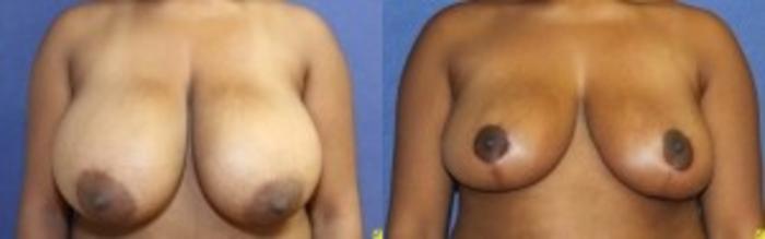 Before & After Breast Reduction Case 65 Front View in Ann Arbor, MI
