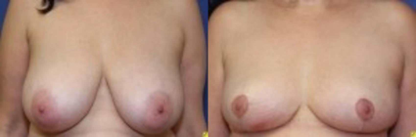 Before & After Breast Reduction Case 67 Front View in Ypsilanti, MI