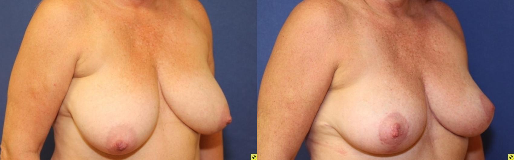 Before & After Breast Reduction Case 69 Right Oblique View in Ypsilanti, MI