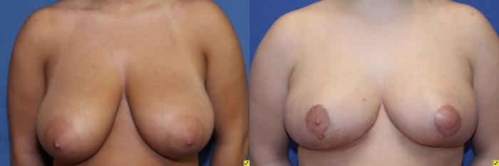 Before & After Breast Reduction Case 70 Front View in Ann Arbor, MI