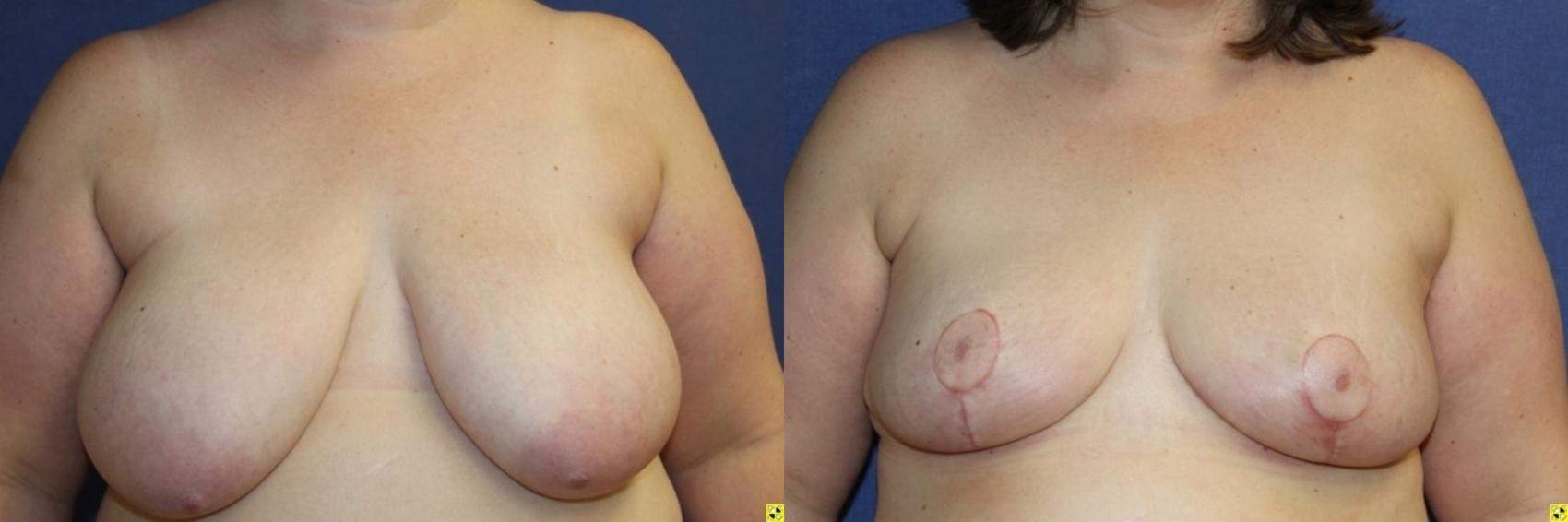 Before & After Breast Reduction Case 71 Front View in Ann Arbor, MI