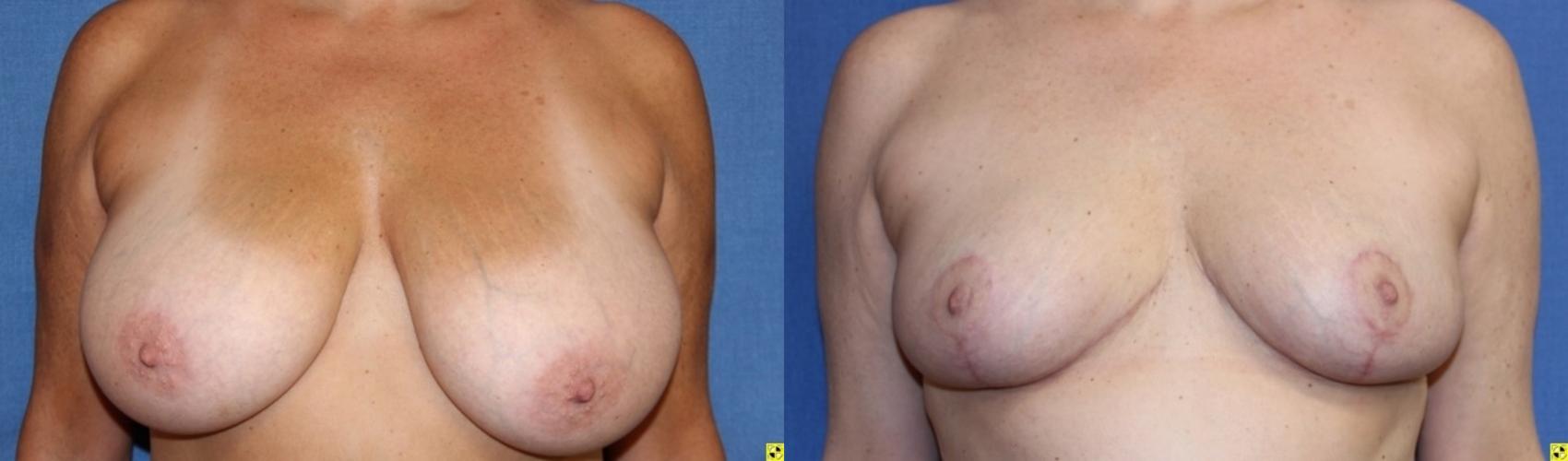 Before & After Breast Reduction Case 72 Front View in Ann Arbor, MI