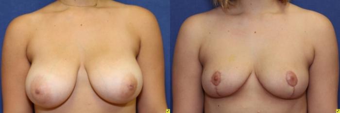 Before & After Breast Reduction Case 73 Front View in Ypsilanti, MI