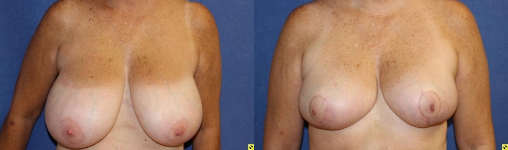 Before & After Breast Reduction Case 74 Front View in Ann Arbor, MI