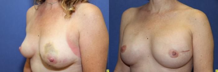 Before & After Breast Reduction Case 75 Left Oblique View in Ann Arbor, MI