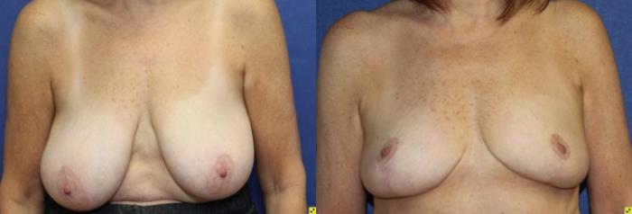 Before & After Breast Reduction Case 76 Front View in Ann Arbor, MI