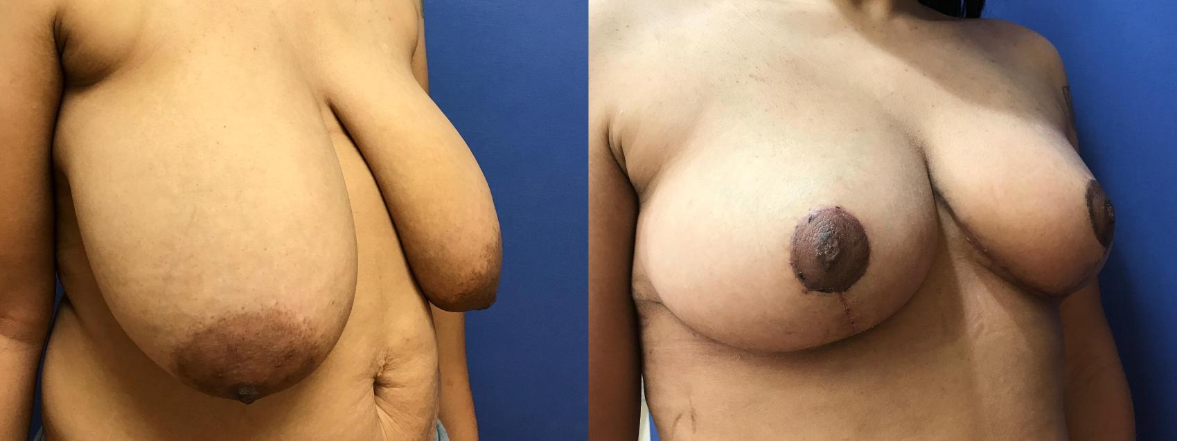 Before & After Breast Reduction Case 77 Right Oblique View in Ann Arbor, MI
