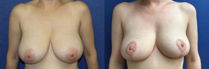 Before & After Breast Reduction Case 78 Front View in Ypsilanti, MI
