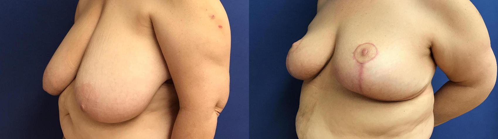 Before & After Breast Reduction Case 79 Left Oblique View in Ypsilanti, MI