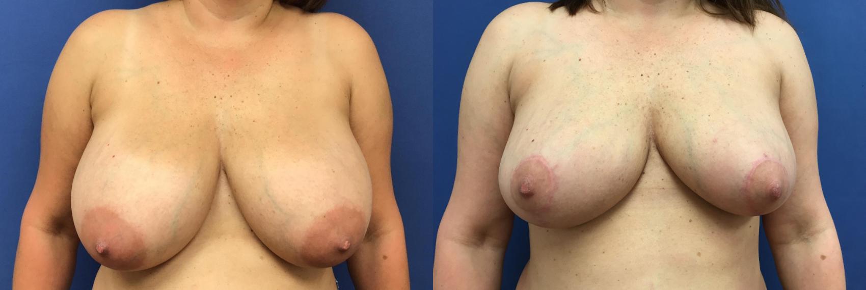 Before & After Breast Reduction Case 80 Front View in Ypsilanti, MI