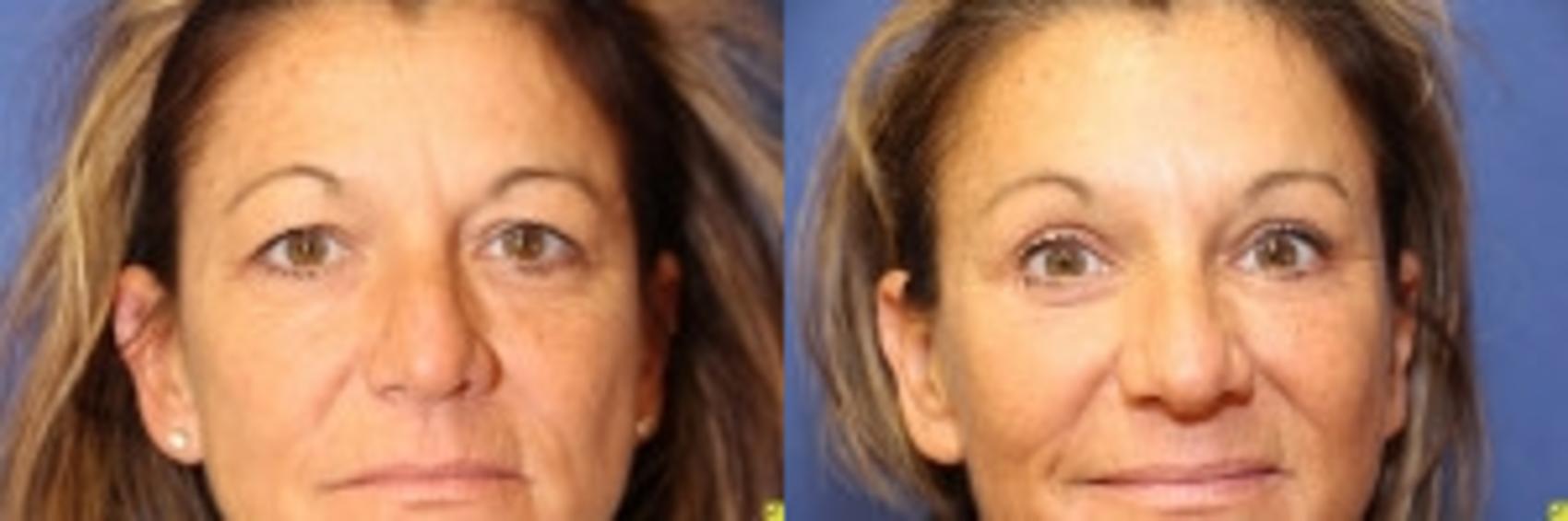 Before & After Brow Lift Case 156 Front View in Ypsilanti, MI