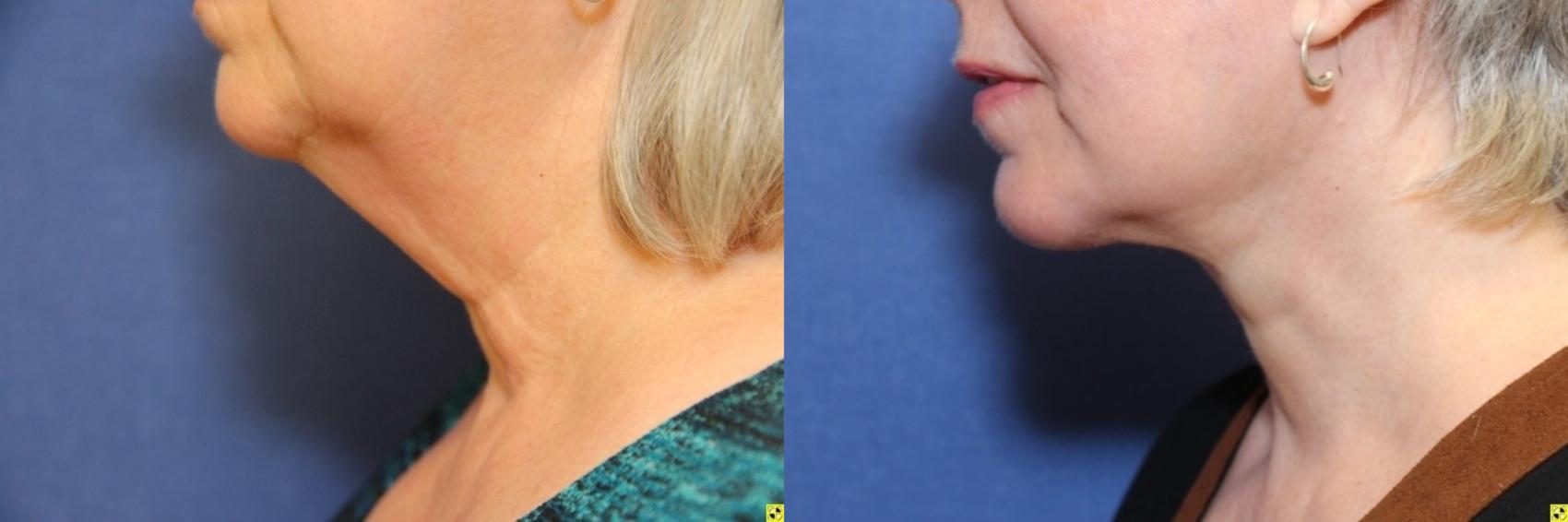 Before & After Chin Augmentation Case 225 Left Side View in Ann Arbor, MI