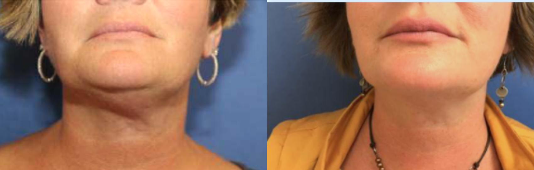 Before & After Chin Augmentation Case 226 Front View in Ann Arbor, MI