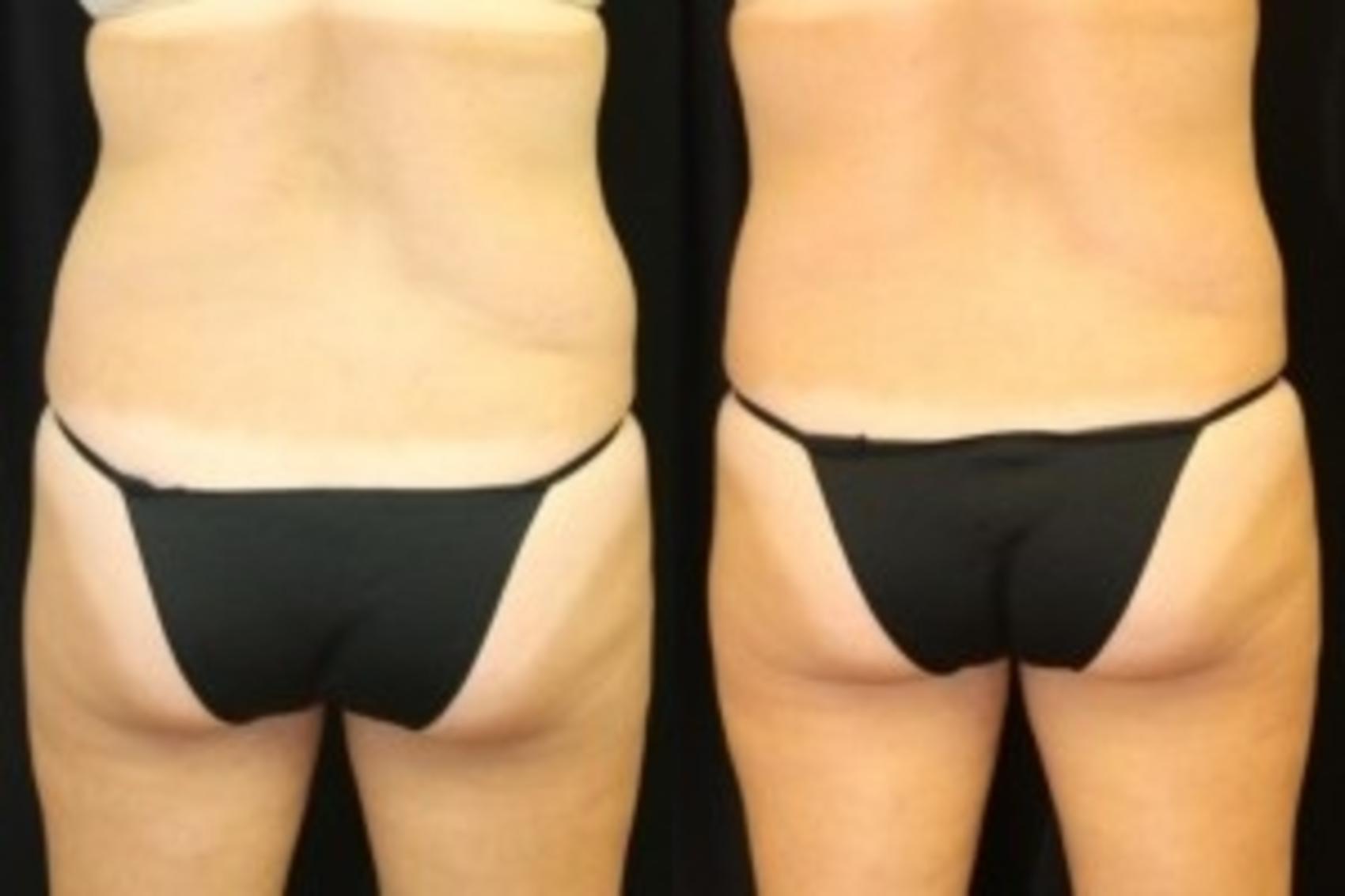 Before & After CoolSculpting® Case 300 Back View in Ypsilanti, MI