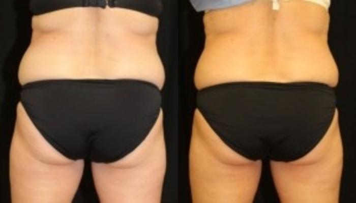 Before & After CoolSculpting® Case 301 Back View in Ann Arbor, MI