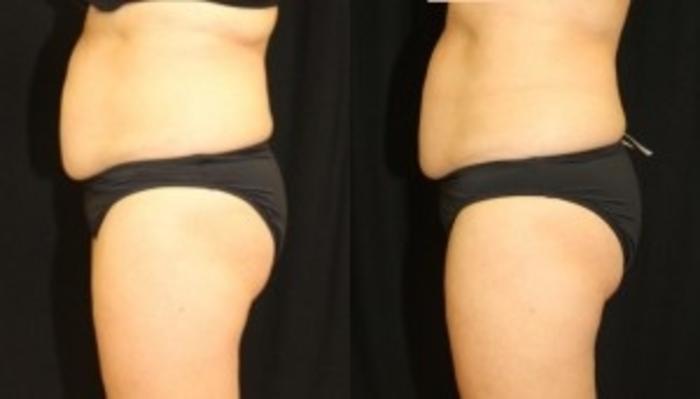 Before & After CoolSculpting® Case 301 Left Side View in Ann Arbor, MI