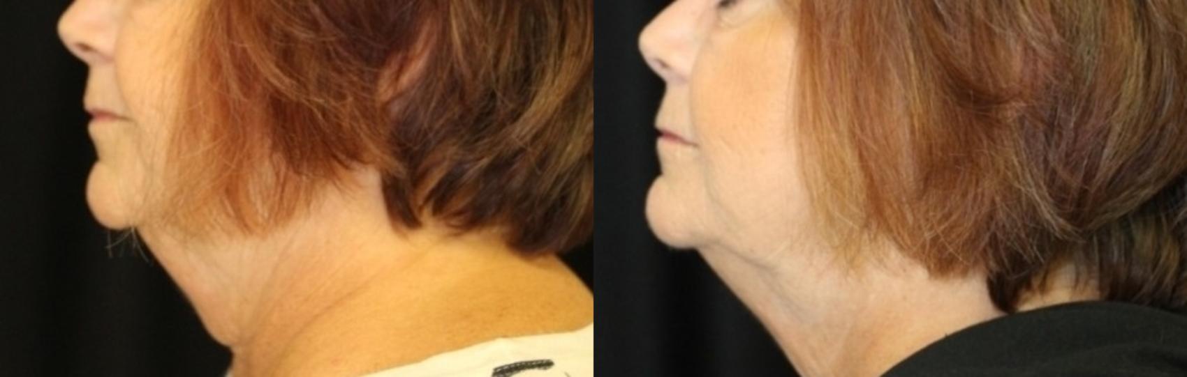 Before & After CoolSculpting® Case 302 Left Side View in Ann Arbor, MI