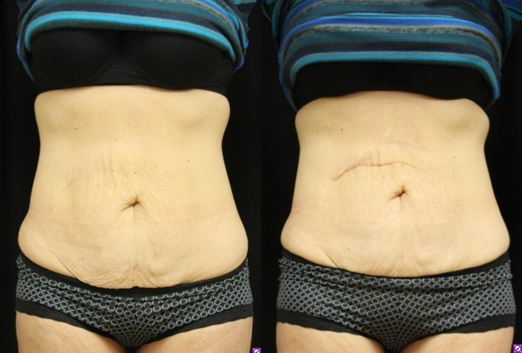 Before & After CoolSculpting® Case 303 Front View in Ypsilanti, MI