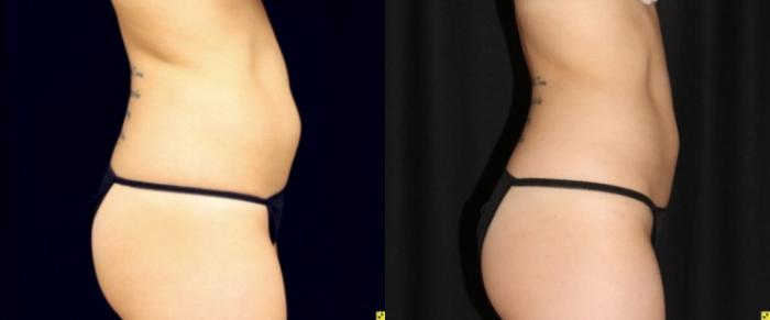Before & After CoolSculpting® Case 305 Right Side View in Ypsilanti, MI