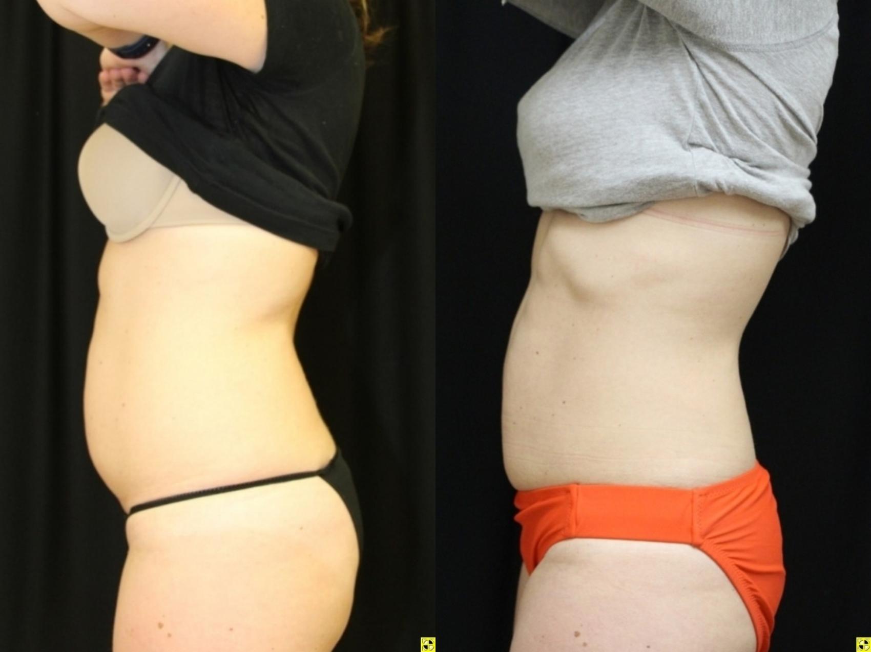 Before & After CoolSculpting® Case 307 Left Side View in Ann Arbor, MI
