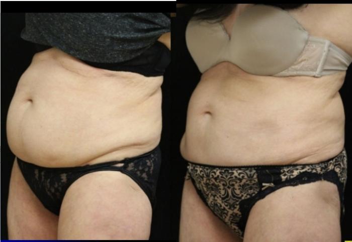 Before & After CoolSculpting® Case 308 Left Oblique View in Ypsilanti, MI