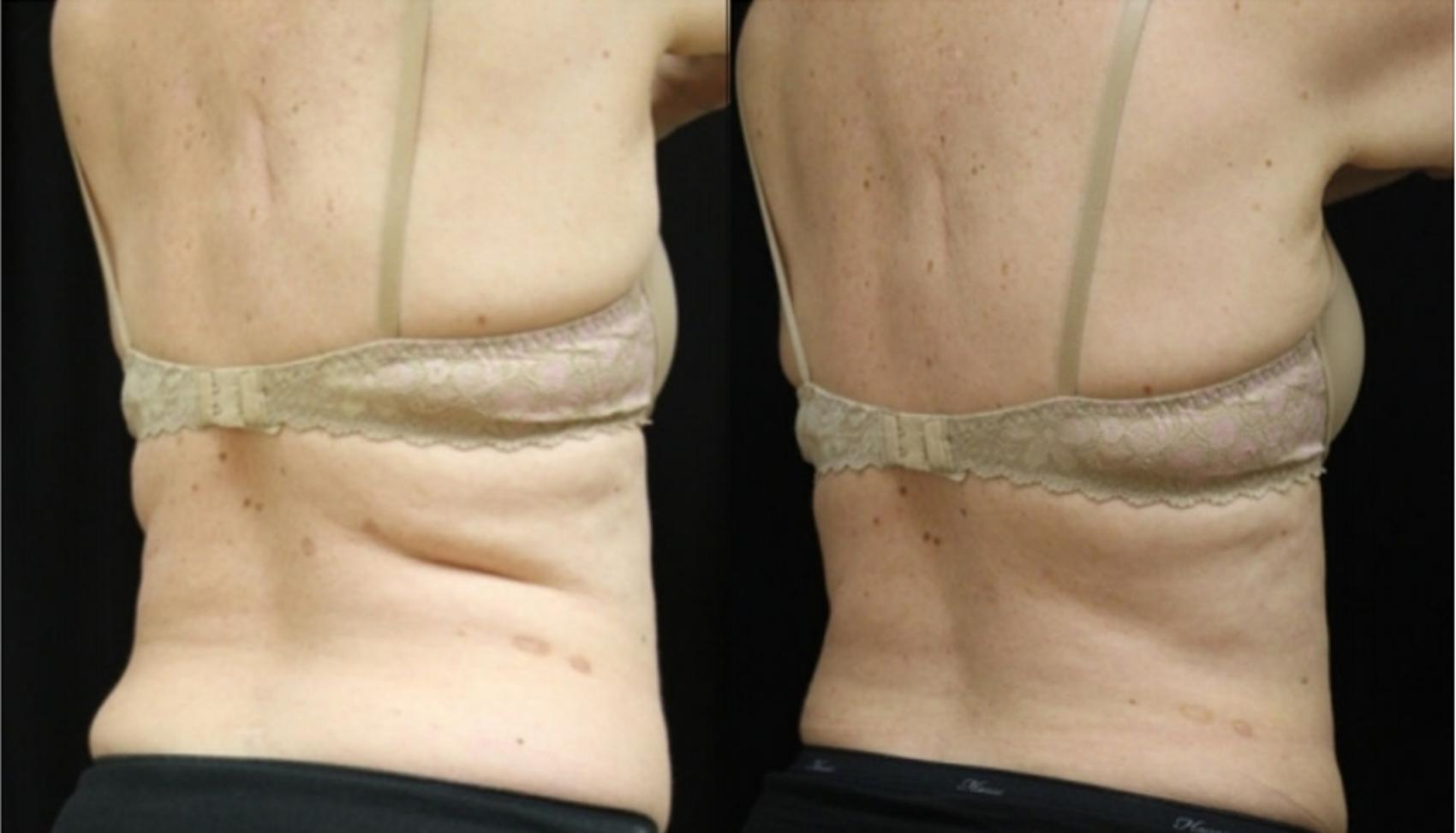 Before & After CoolSculpting® Case 309 Back View in Ypsilanti, MI