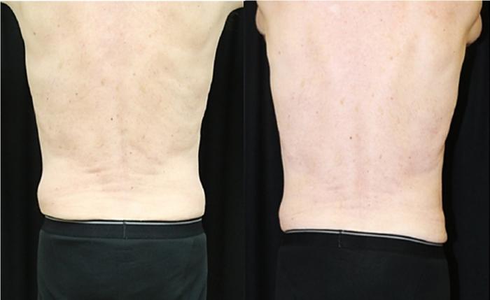 Before & After CoolSculpting® Case 310 Back View in Ann Arbor, MI