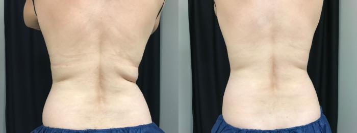 Before & After CoolSculpting® Case 311 Back View in Ann Arbor, MI