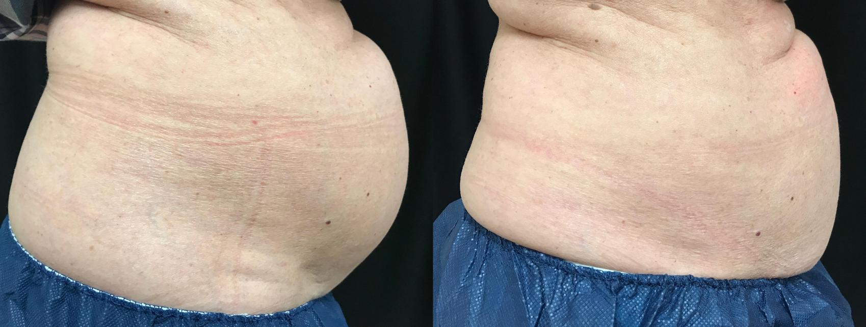 Before & After CoolSculpting® Case 312 Right Side View in Ann Arbor, MI