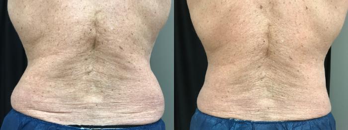 Before & After CoolSculpting® Case 313 Back View in Ypsilanti, MI