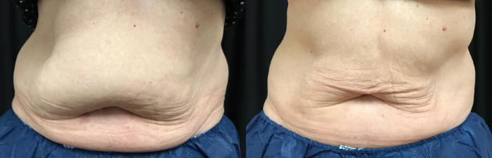 Before & After CoolSculpting® Case 314 Front View in Ypsilanti, MI