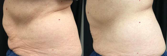Before & After CoolSculpting® Case 314 Right Side View in Ypsilanti, MI