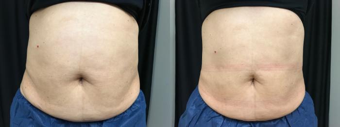 Before & After CoolSculpting® Case 315 Front View in Ann Arbor, MI
